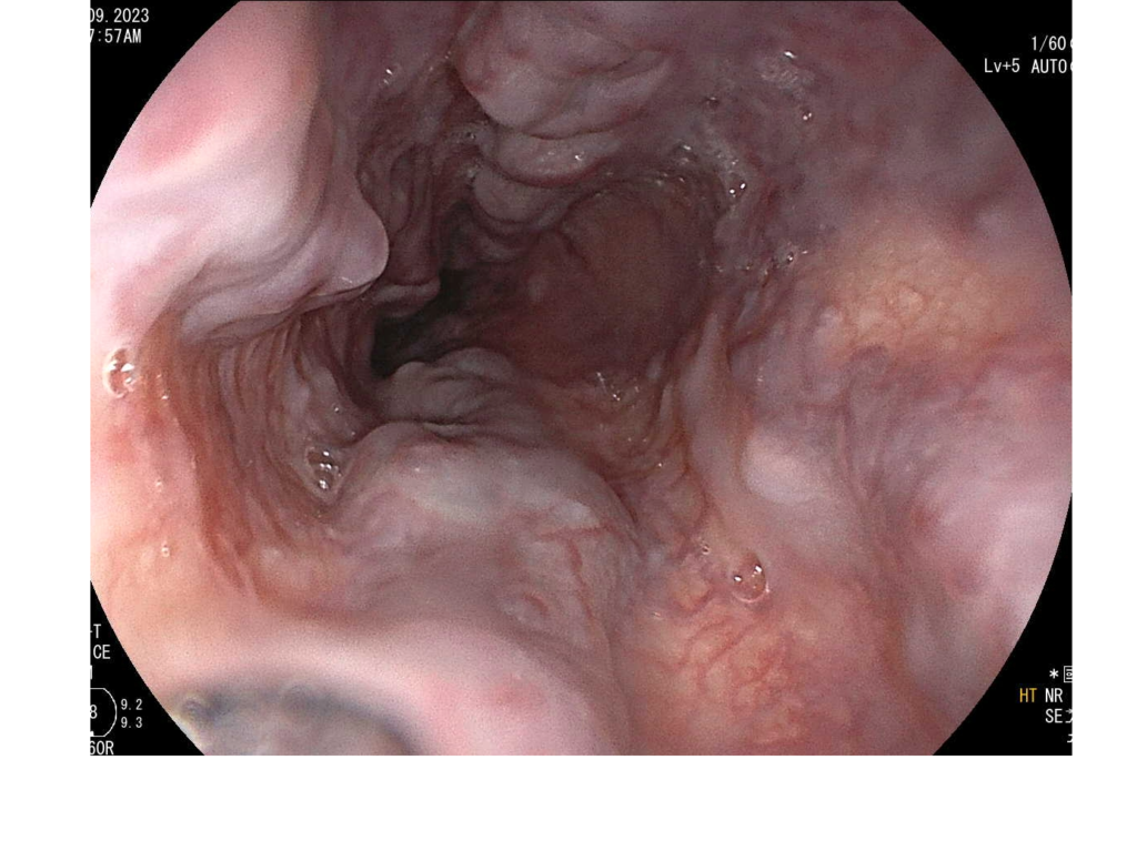 Endoscopia-Varices Esofágicas2