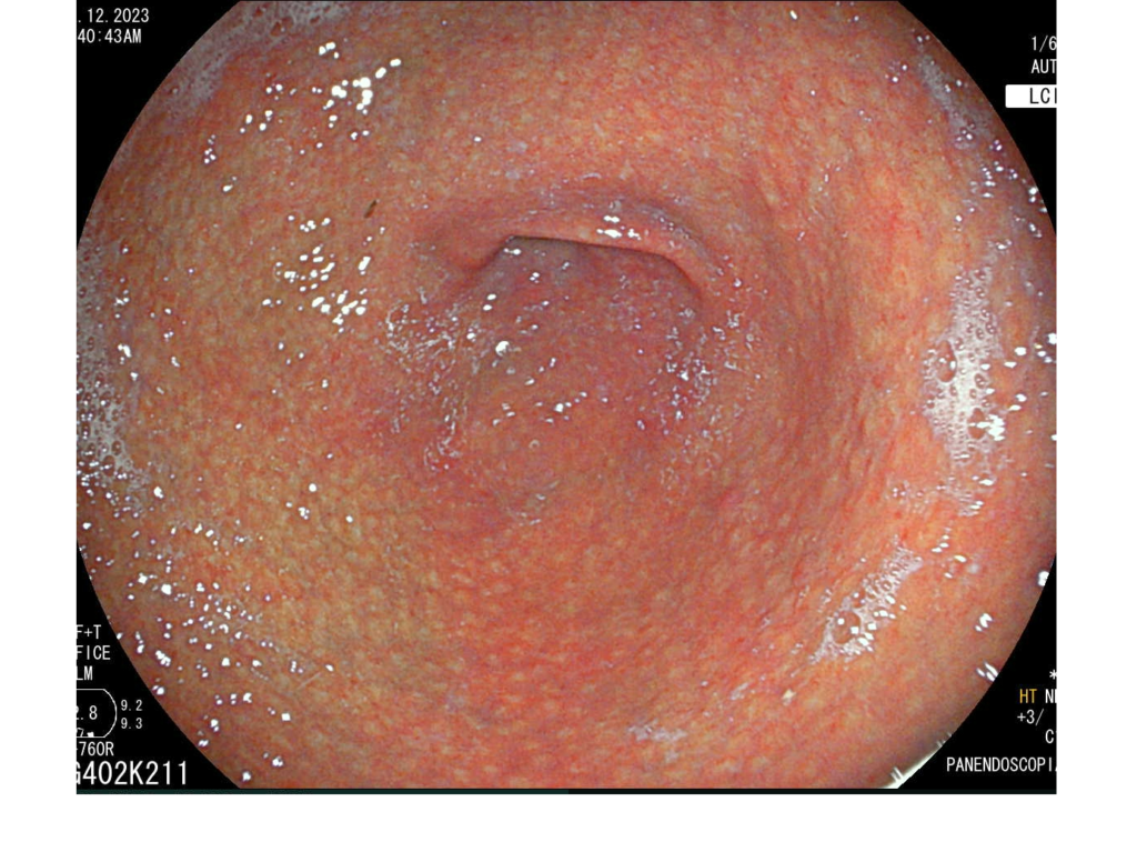 Endoscopia-H. pylori