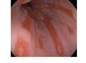 Endoscopia-Esofagitis