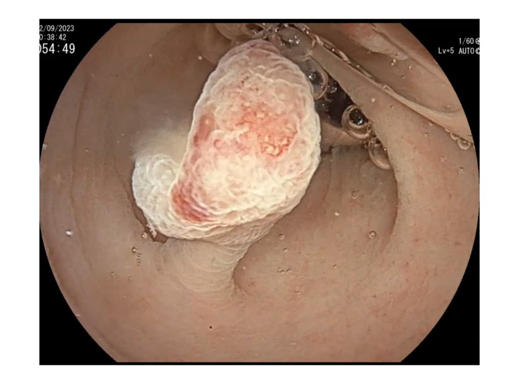 colonoscopia-pólipos y adenomas