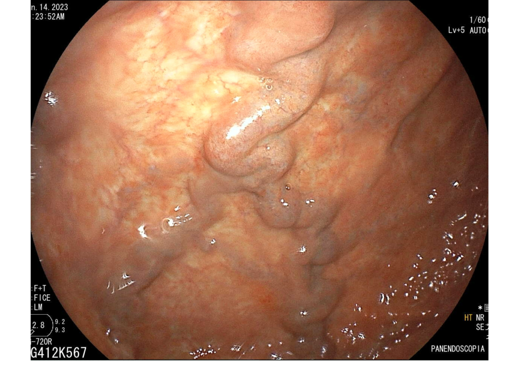 Endoscopia-Varices Gástricas