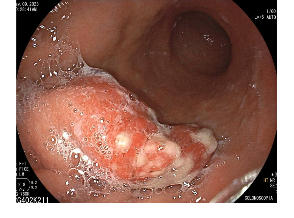 Endoscopia-pólipos gástricos