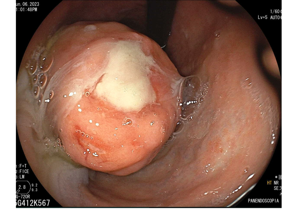 Endoscopia-Tumor Subepitelial