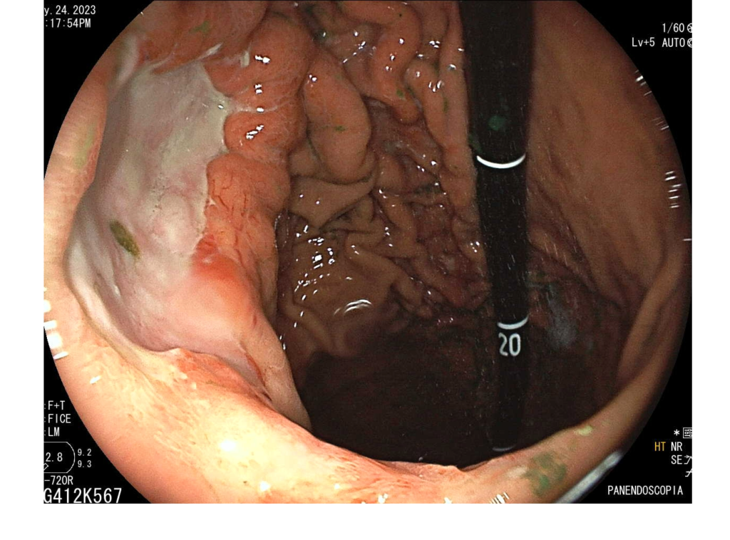 Endoscopia-Cáncer gástrico