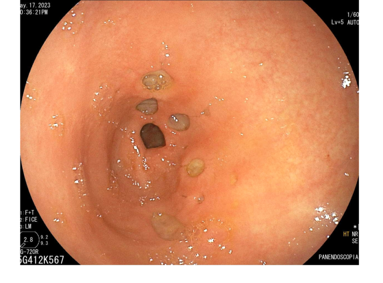 Endoscopia-Ulceras Gástricas