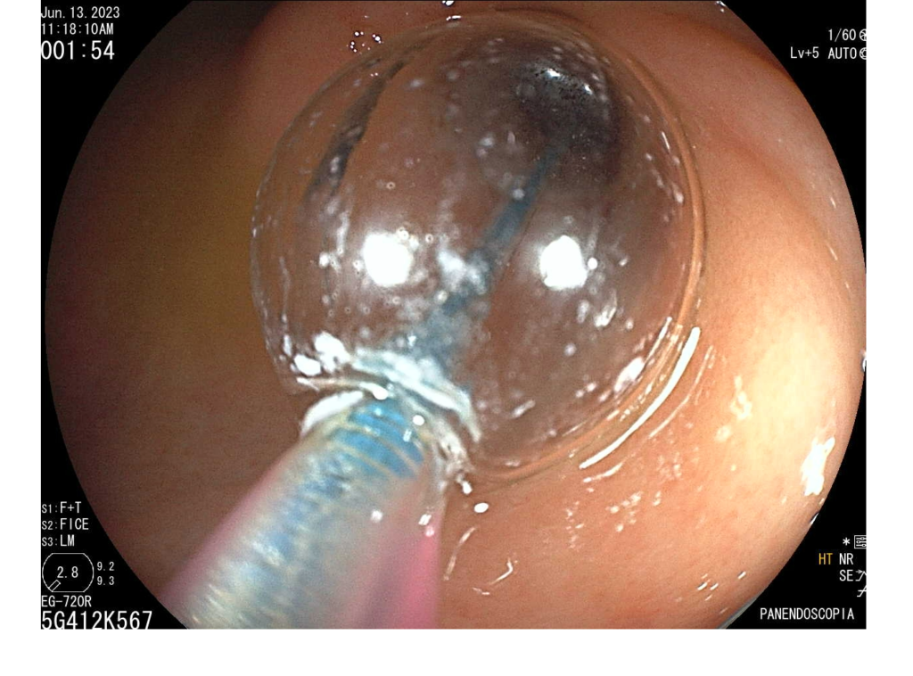 Endoscopia-Estenosis-disfagia