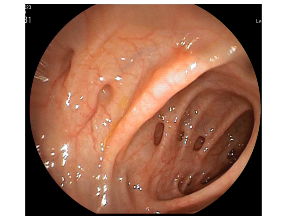 colonoscopia-Diverticulos