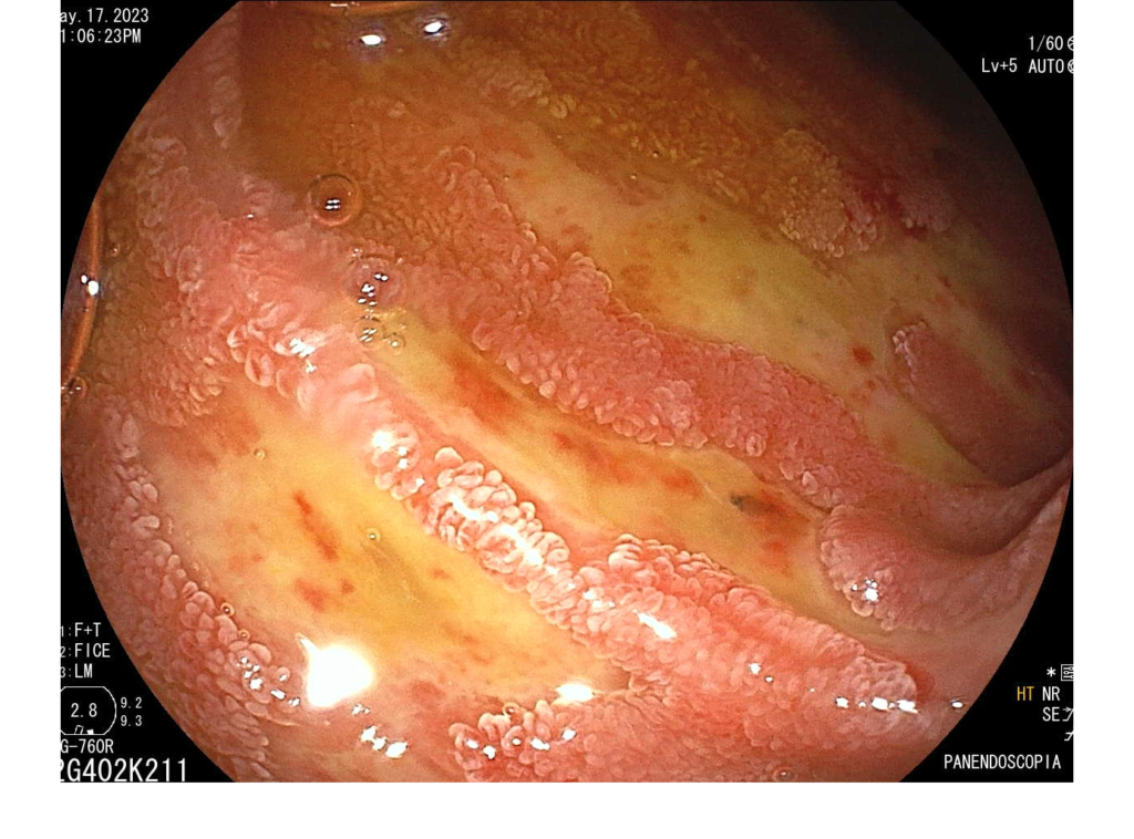 Endoscopia-Ulceras Duodenales