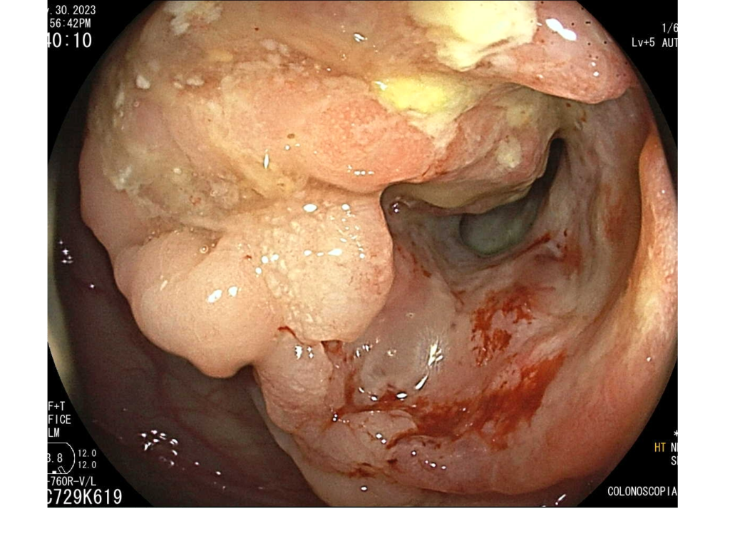 colonoscopia-Cáncer de Colon