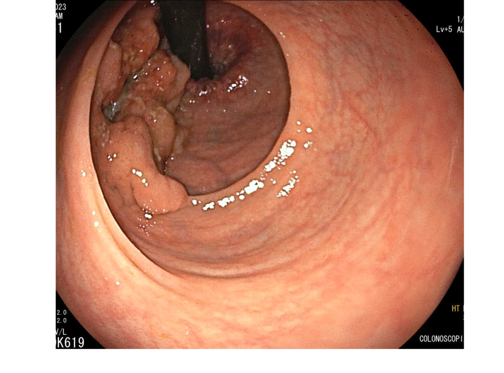 Cáncer de recto por colonoscopia