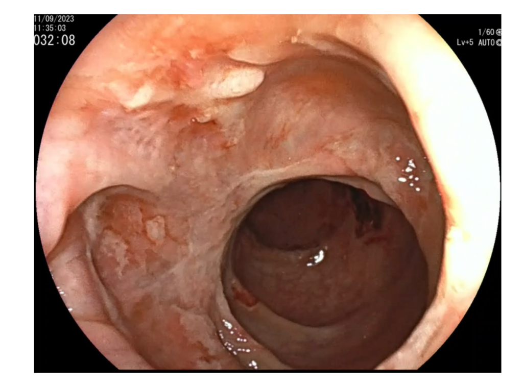 colonoscopia-CUCI-Crohn