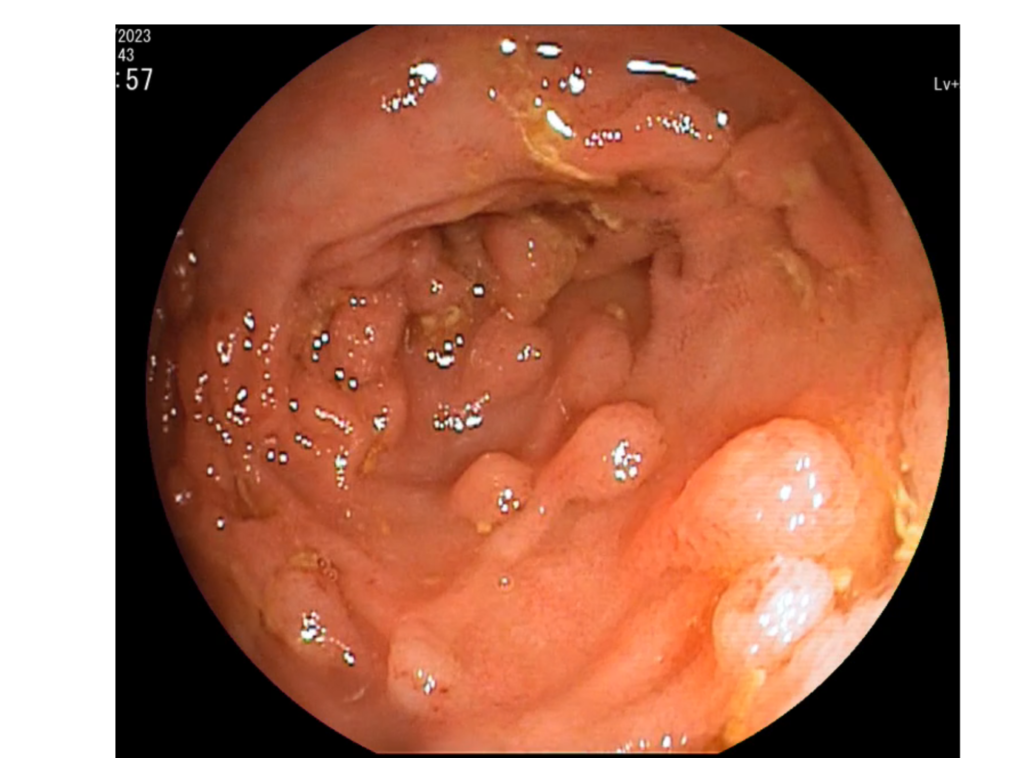 colonoscopia-poliposis adenomatosa familiar