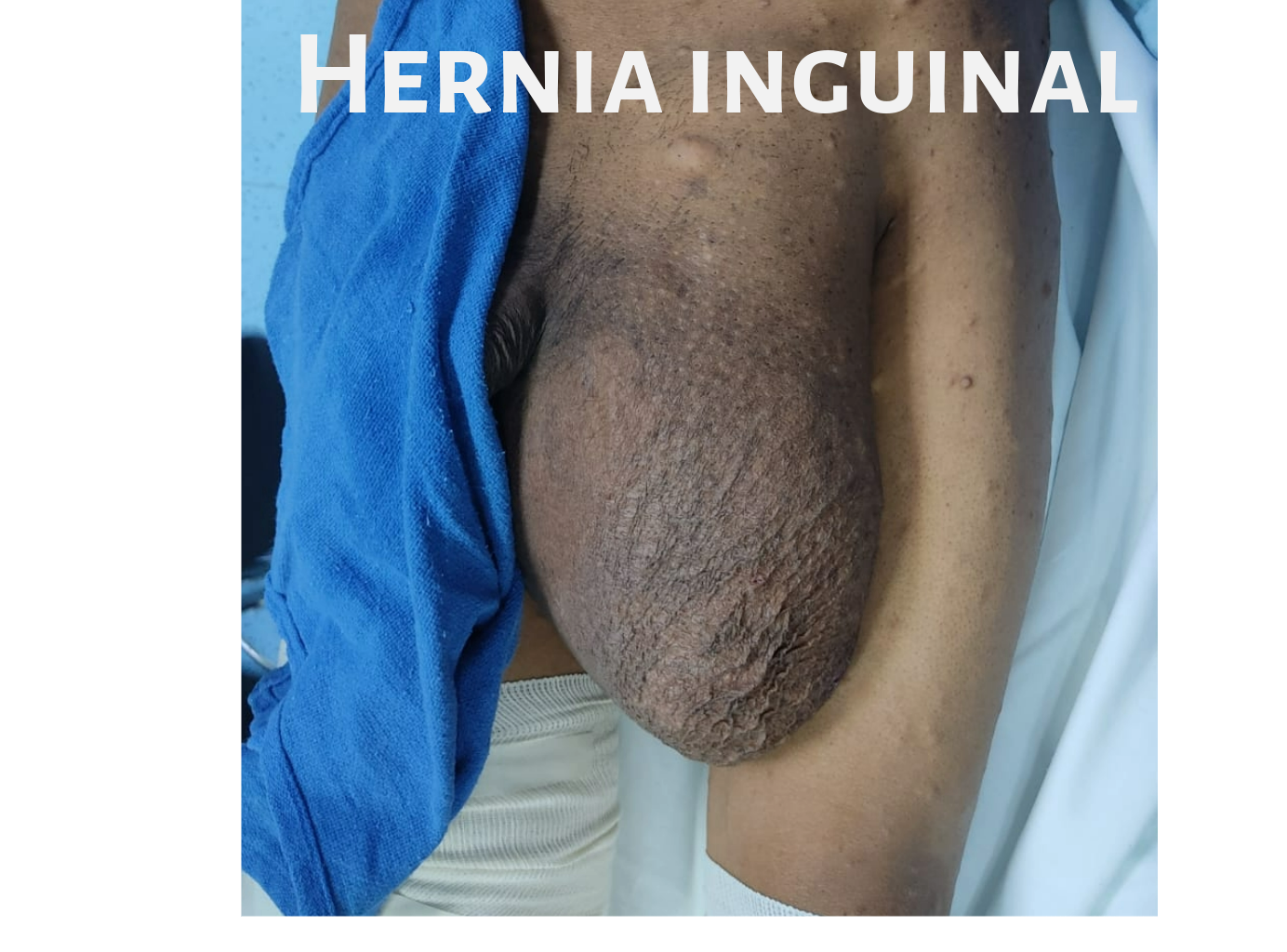 Cirugía-Hernia inguinal-plastia Inguinal