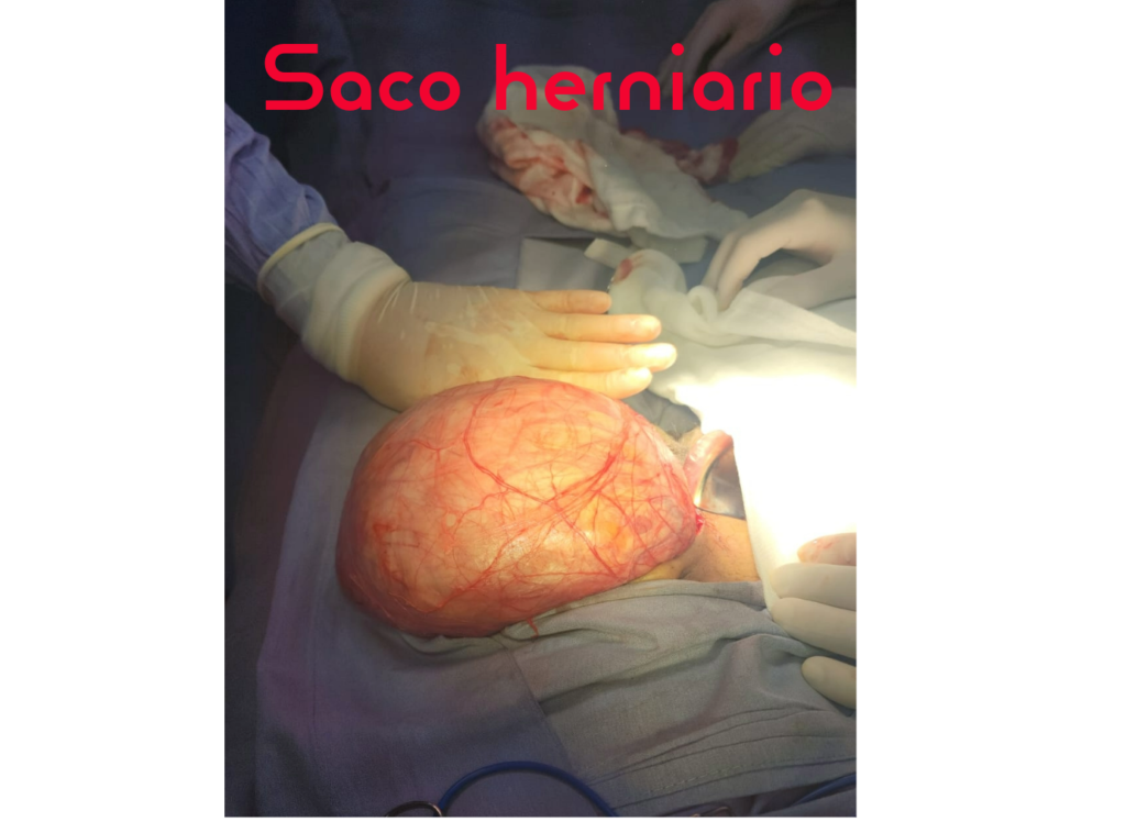 Cirugía de Hernia-saco herniario