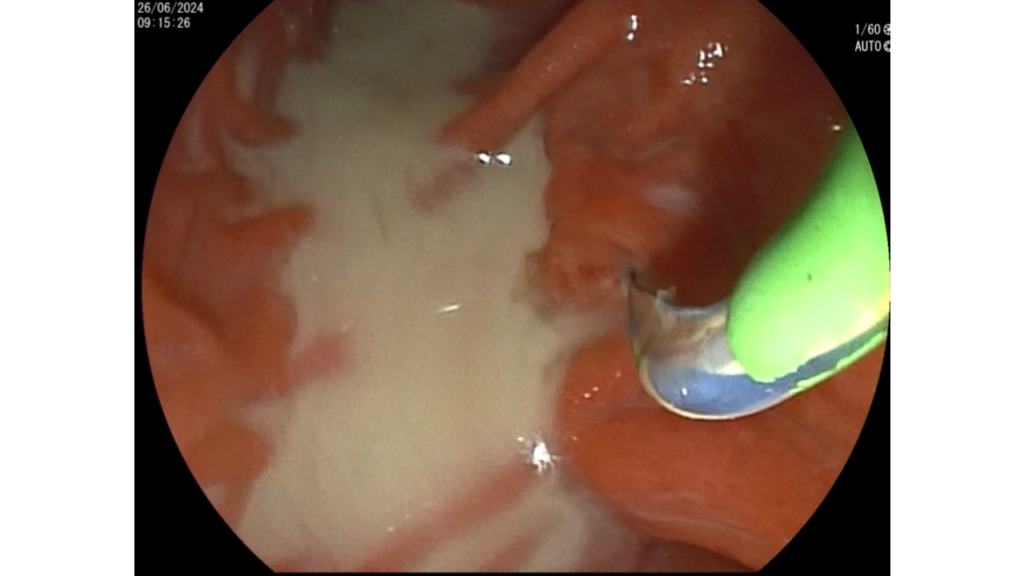 CPRE-Colangitis