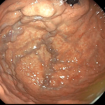 Padecimientos gastrointestinales-Varices Gástricas-Endoscopia - blog