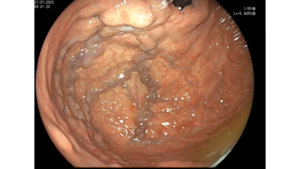 Padecimientos gastrointestinales-Varices Gástricas-Endoscopia - blog