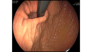 Padecimientos gastrointestinales-Hernia Hiatal-Endoscopia - blog