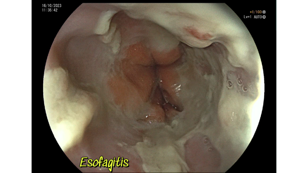 Esofagitis