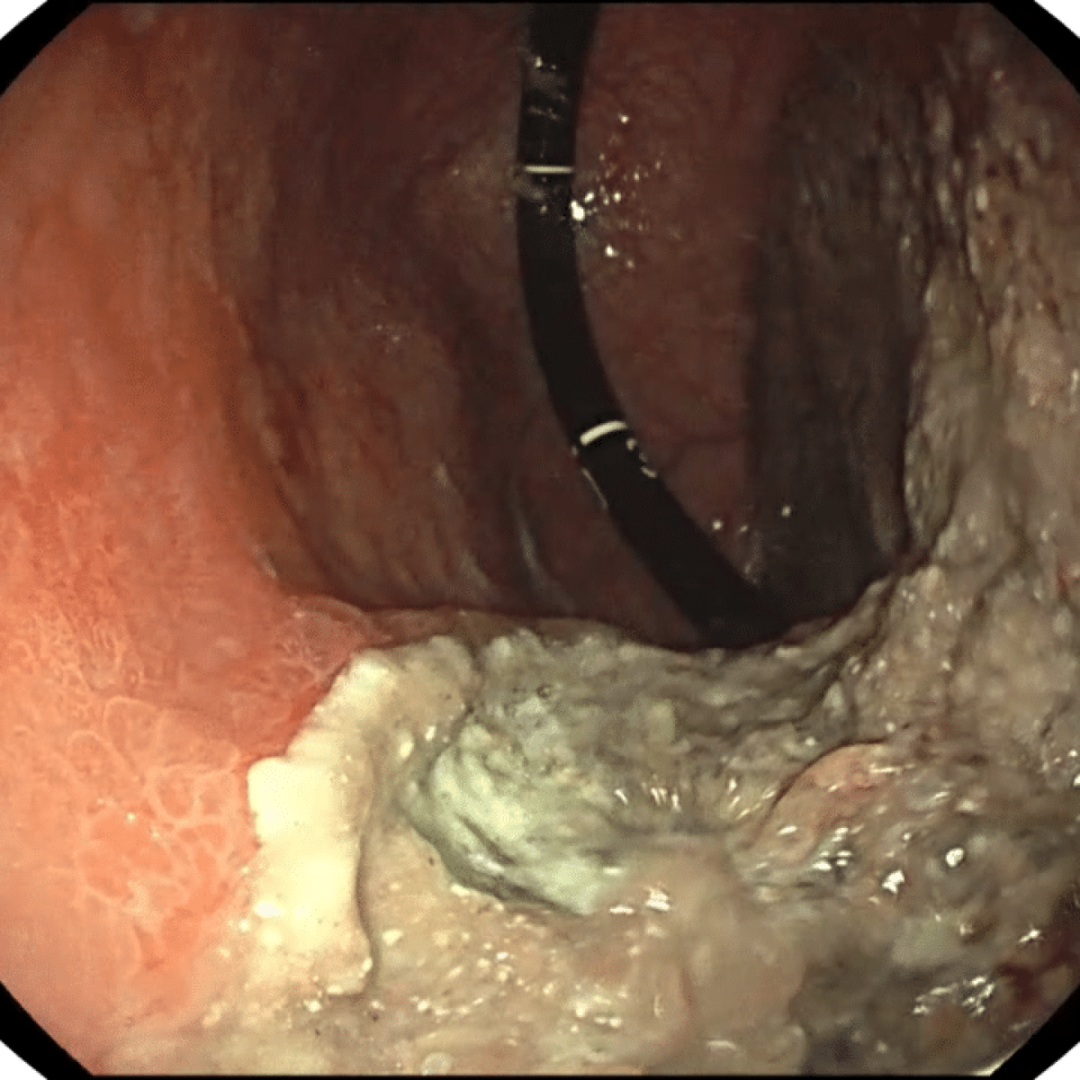 Cáncer Gástrico